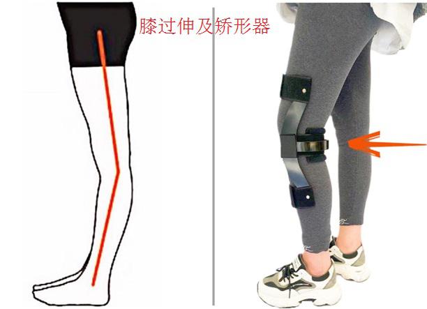 膝过伸及矫形器