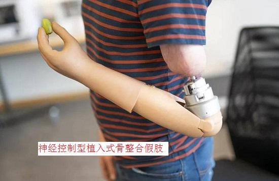 神经控制型植入式骨整合假肢