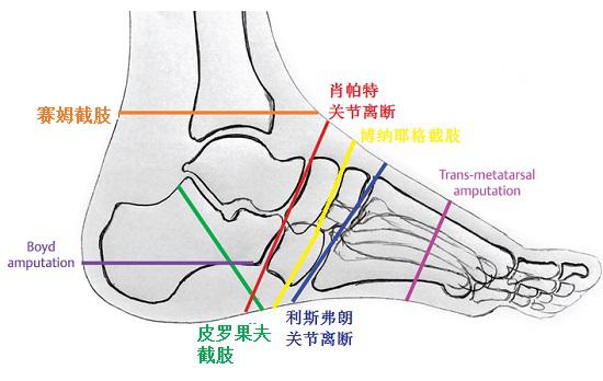 跗部截肢的类型