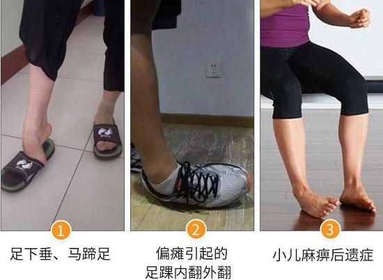 足下垂