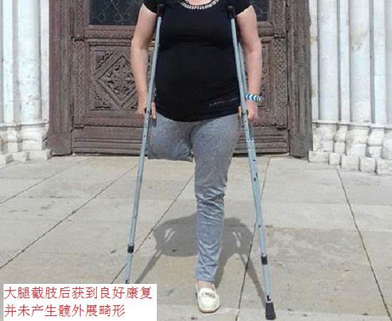 截肢并康复后