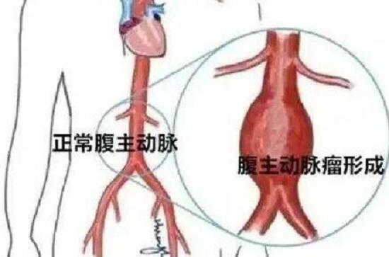 腹主动脉瘤