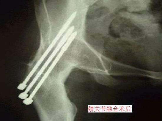 髋关节融合术后