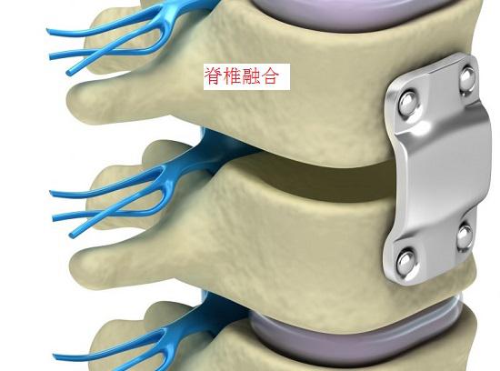 脊柱融合