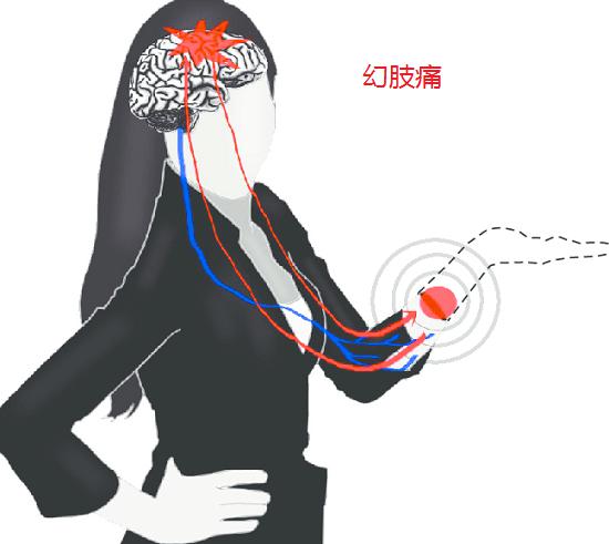 幻肢痛与幻肢觉