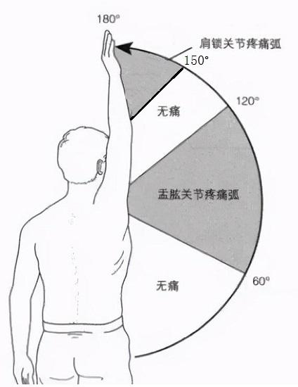 肩峰撞击的诊断