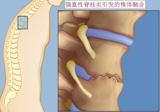 强直性脊柱炎引发椎体融合