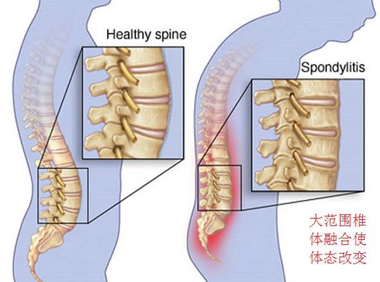 强直性脊柱炎引发椎体融合和脊柱屈曲