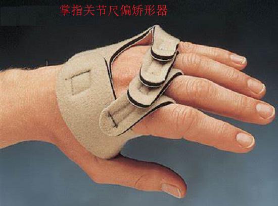 掌指关节尺偏矫形器