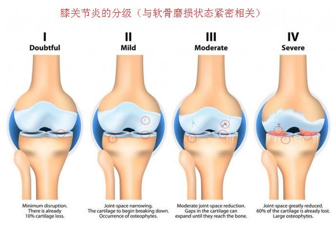 膝关节炎的风级