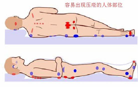 容易出现压疮的人体部位
