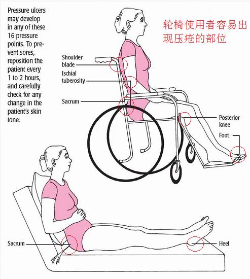轮椅使用者容易出现压疮的部位