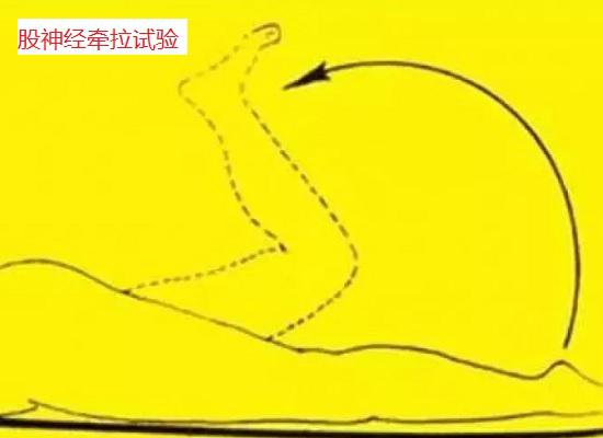 股神经牵拉试验