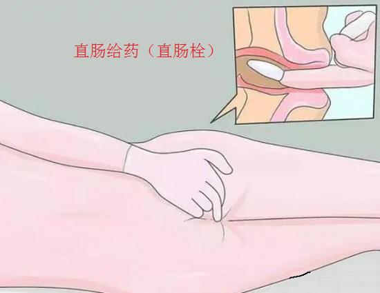 直肠给药止痛