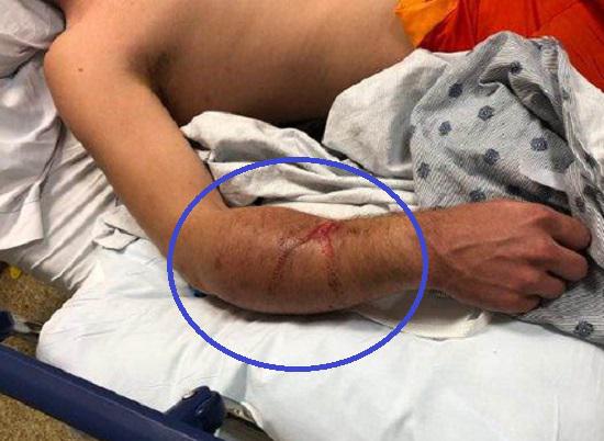 前臂骨筋膜综合征的症状