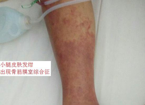 小腿骨筋膜室综合征的皮肤表现