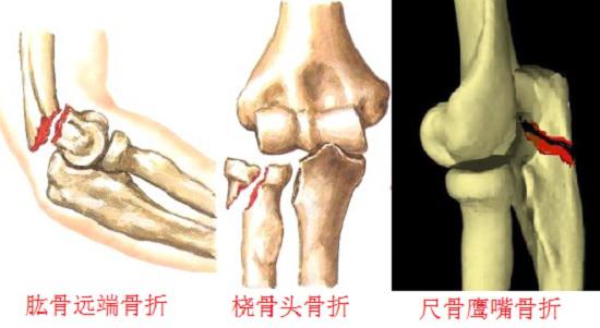 肘关节骨折的三种类型