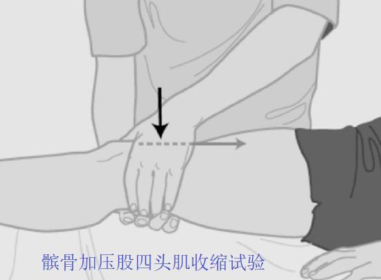髌骨加压股四头肌收缩试验