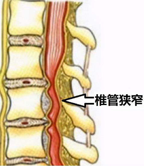 椎管狭窄