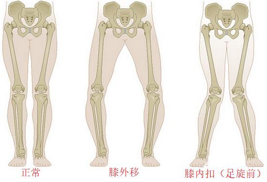 畸形的踝、膝、髋关节