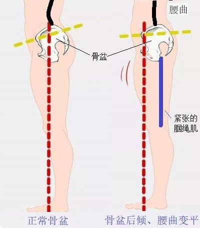 腘绳肌与腰椎曲度的关系