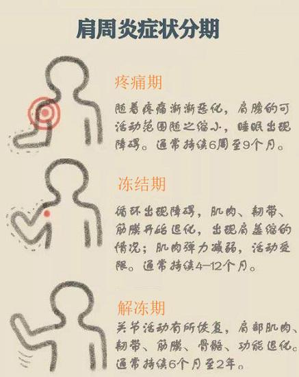肩周炎症状分期