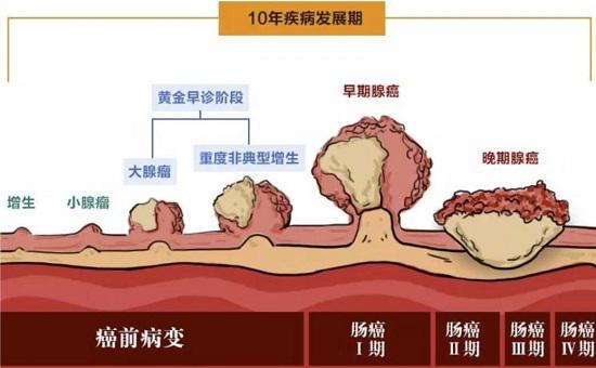 肠息肉的癌变过程