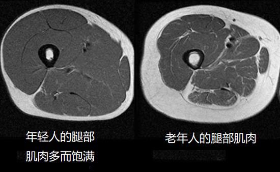 老年人的肌肉萎缩