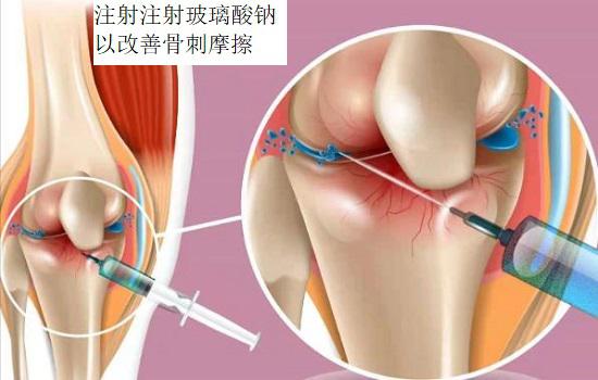给膝关节注射玻璃酸钠