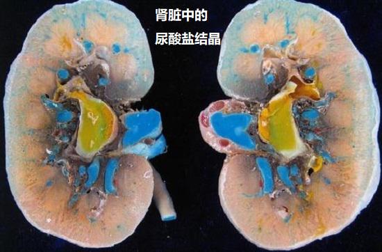 肾脏中的尿酸盐结晶