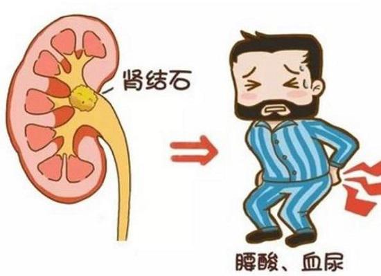 肾结石